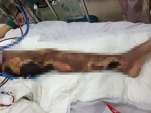 hoai tu chan vi dieu tri theo bac si google