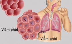 Cách phòng bệnh viêm phổi hiệu quả trong thời tiết nồm, ẩm