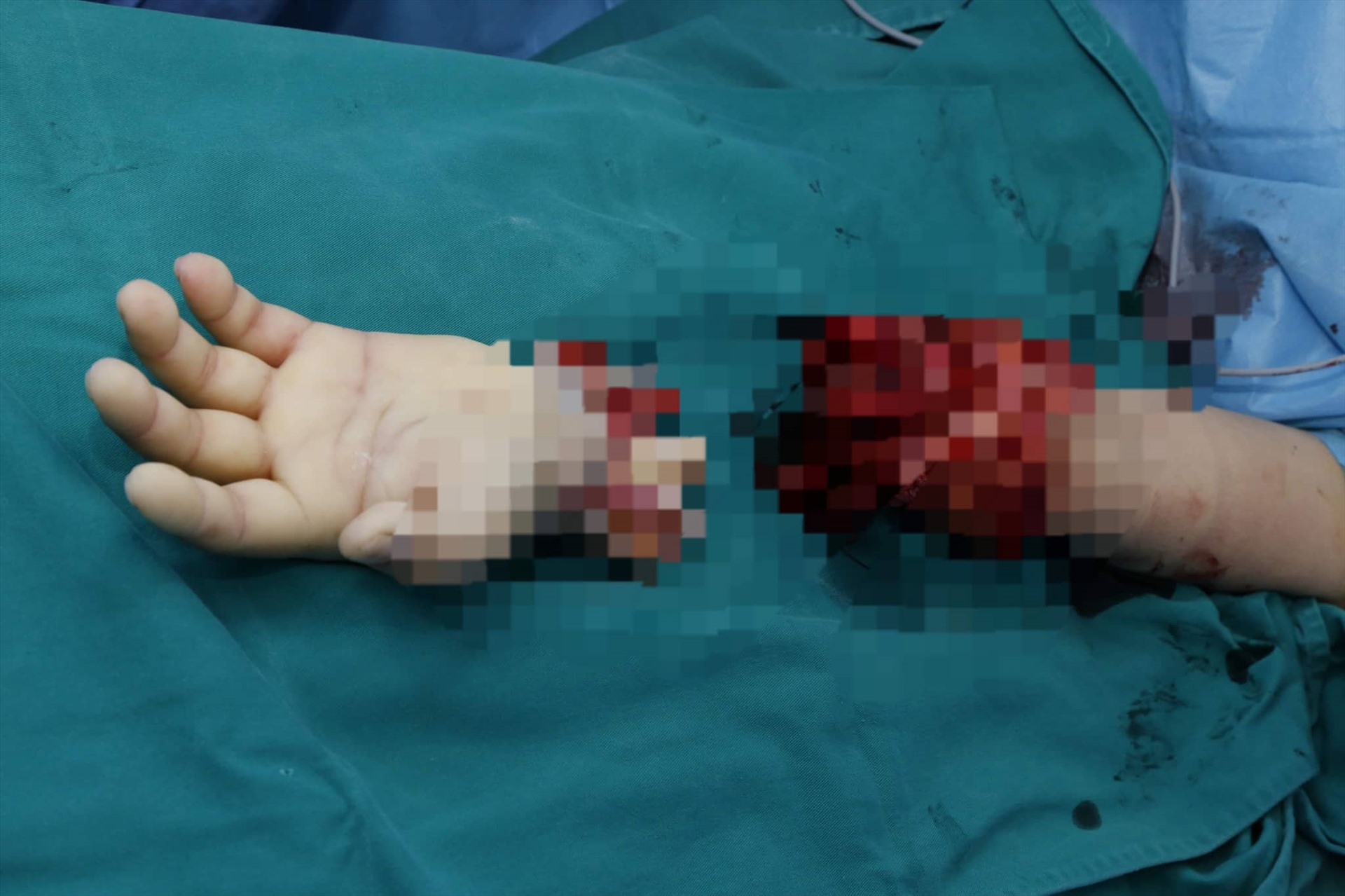 Ca ghép chi thể từ người cho sống đầu tiên trên thế giới là ở Việt Nam