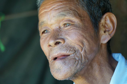 cu ong campuchia sau ca phau thuat bo nuou rang khong lo