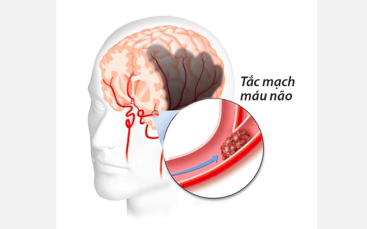 5 dấu hiệu cảnh báo mạch máu bị tắc nghẽn: Nên đi khám ngay khi vừa phát hiện - 1