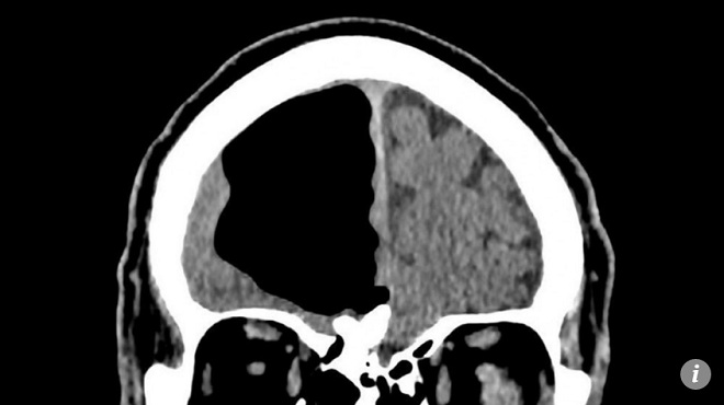 nhap vien vi dau dau kinh ngac thay trong nao co khoang trong lon