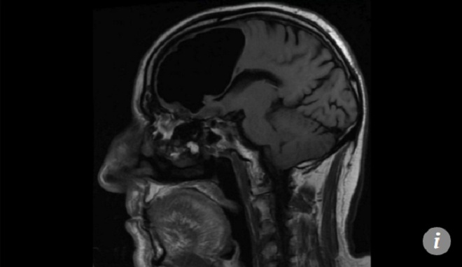 nhap vien vi dau dau kinh ngac thay trong nao co khoang trong lon