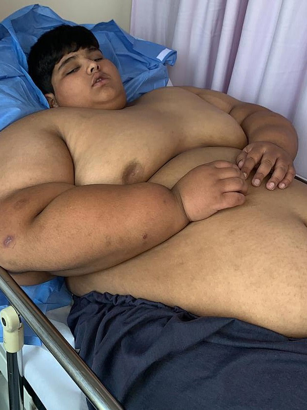 Cậu bé nặng nhất thế giới phải phẫu thuật để sống sót cau be nang nhat the gioi phai phau thuat de song sot