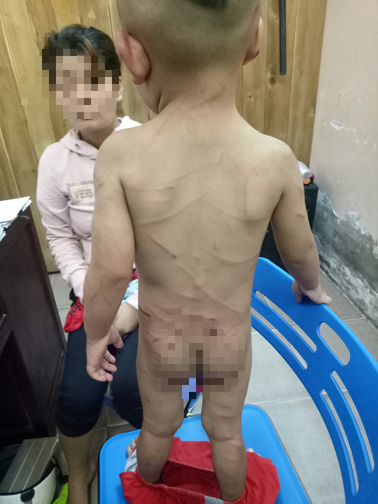 vu be 3 tuoi bi cha duong danh da man hang xom tiet lo thong tin quotsocquot