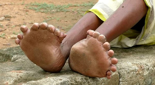 nguoi phu nu co 19 ngon chan 12 ngon tay