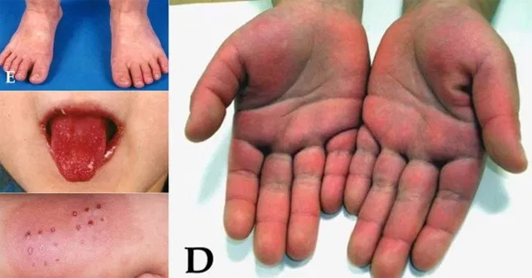 Biến chứng lạ ở ba em bé nhiễm Covid-19 bien chung la o ba em be nhiem covid 19