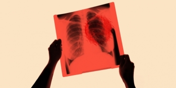 Hơn 50% người bị ung thư phổi tử vong chỉ sau 1 năm: Cần làm gì để phòng ngừa?