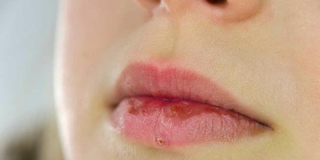 6 thói quen xấu khiến đôi môi nứt nẻ, khô xác - 2