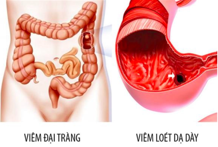 3 dấu hiệu sau ăn cảnh báo dạ dày có bệnh: Làm 6 việc để bệnh không nặng thêm - 2