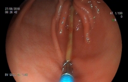 mat gan 3 trieu bangnam vi tre nhet di vat vao mui tai