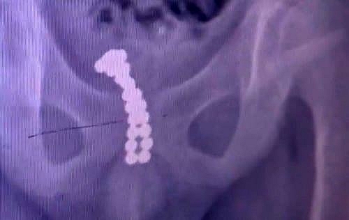 Cậu bé tự nhét 26 viên bi vào dương vật