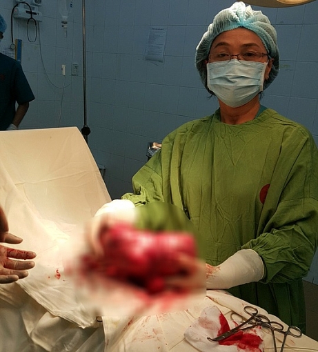 bung to nhu thai 8 thang boc ra u xo 25 kg