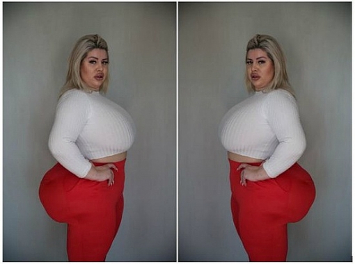 Cô gái phẫu thuật bơm mông liên tục để có vòng ba khủng