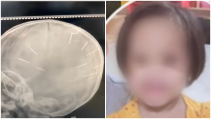 Sức khoẻ bé gái 3 tuổi ở Hà Nội bị đinh ghim vào đầu hiện thế nào? - 1