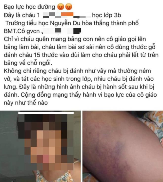 Vì sao học sinh lớp 3 ở Đắk Lắk bị cô giáo đánh bầm tím đùi - 2